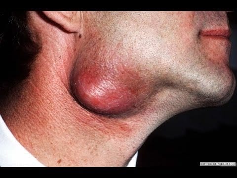 huge-neck-cyst-drained-and-its-n.jpg