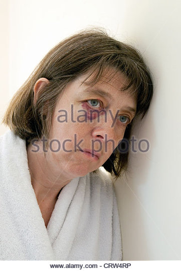 a-middle-aged-caucasian-woman-with-a-black-eye-suggesting-domestic-crw4rp.jpg