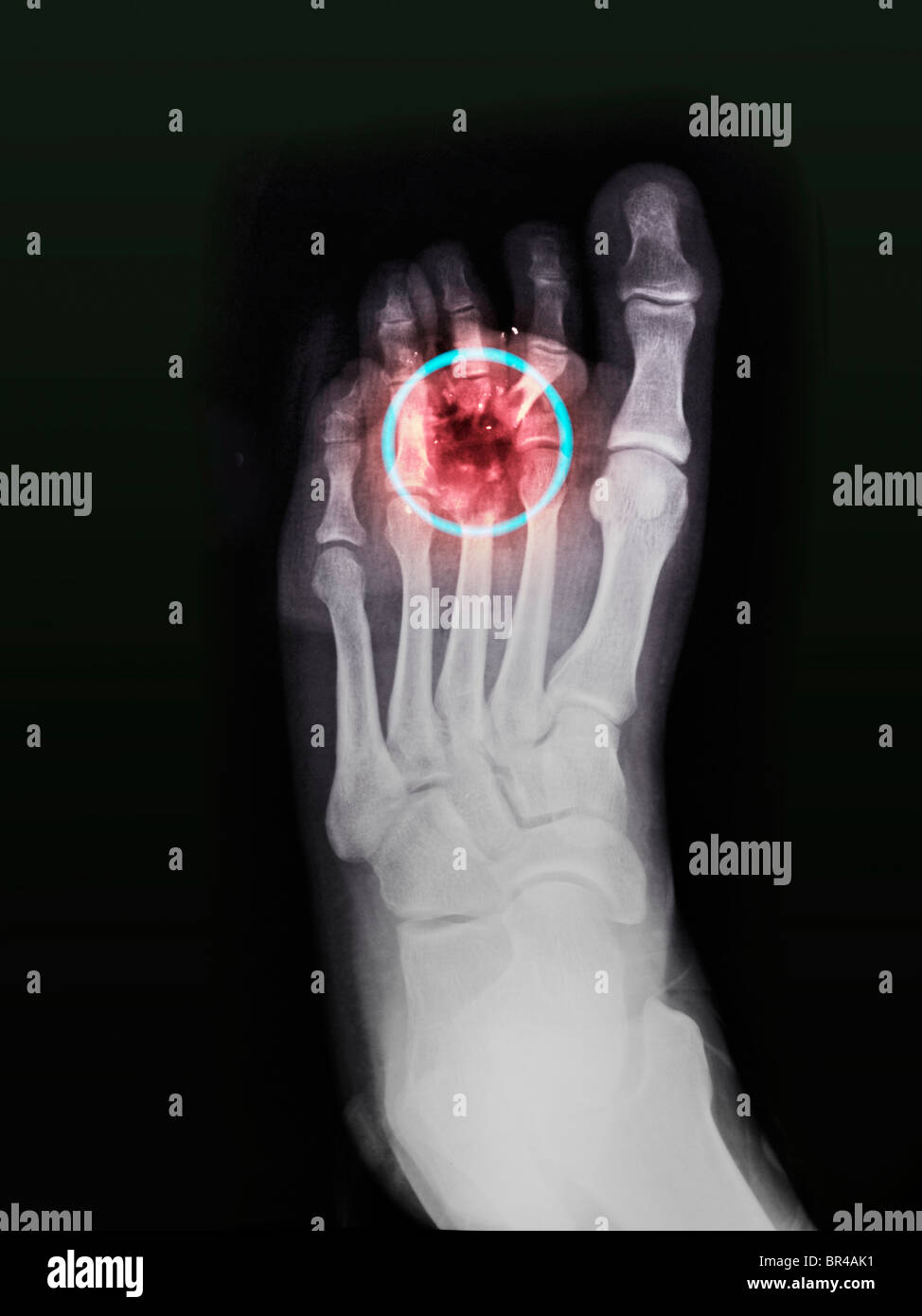 foot-x-ray-of-a-34-year-old-man-who-shot-himself-accidentally-in-the-BR4AK1.jpg